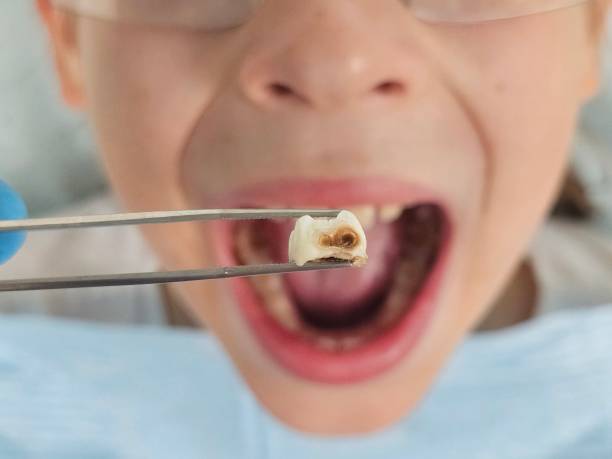 Best Emergency Tooth Extraction in Liberty, UT
